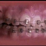 Straight teeth in under 60 seconds!